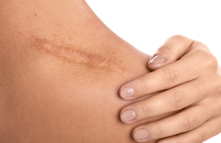 Narbenbehandlung Heidelberg – Laser, Microneedling und Peelings ahaufnahme einer Schulter mit Narbe – Symbolbild für Narbenbehandlung in der ATOS Dermatologie Heidelberg mit Laser, Microneedling und chemi