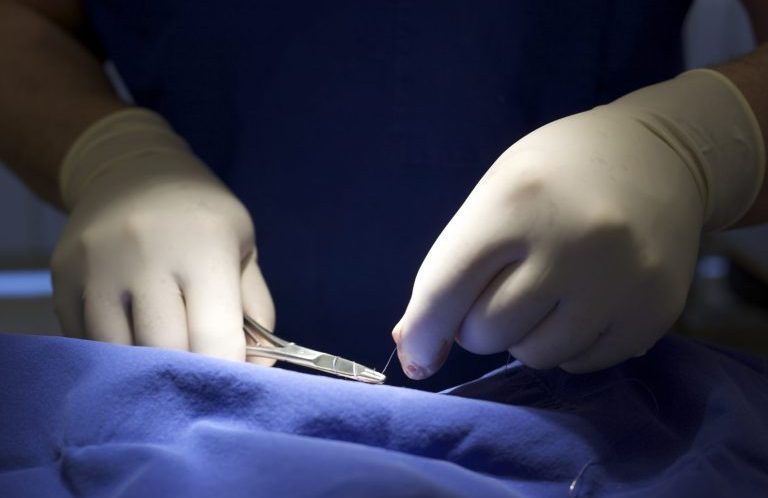 Operative Dermatologie Heidelberg – ambulante Eingriffe mit Präzision. Hautchirurgische Entfernung eines Muttermals in der ATOS Dermatologie Heidelberg.